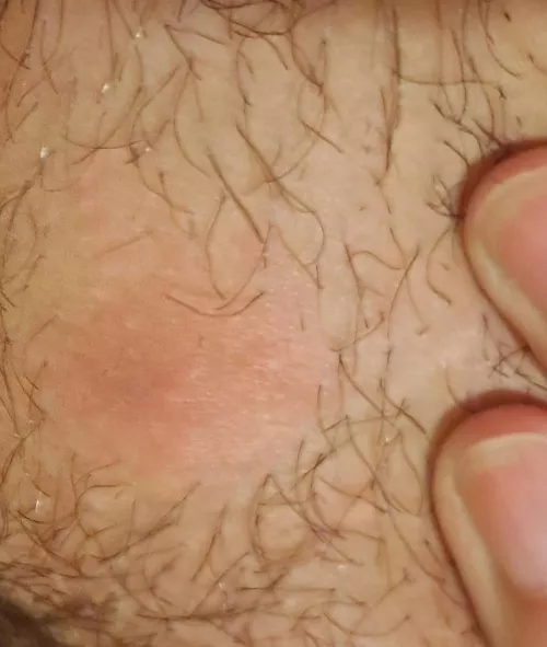 This cyst(?) has been forming for a week. Can't wait for the head to come up! (NSFW for location) by mountainnose1994