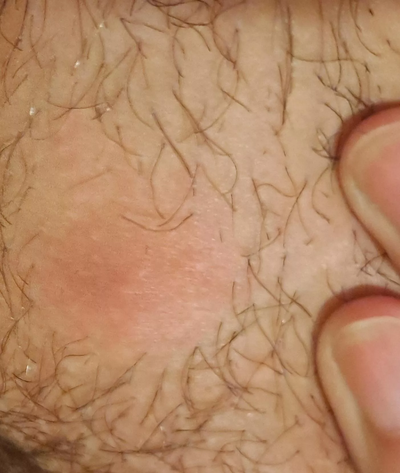 This cyst(?) has been forming for a week. Can't wait for the head to come up! (NSFW for location) posted by mountainnose1994