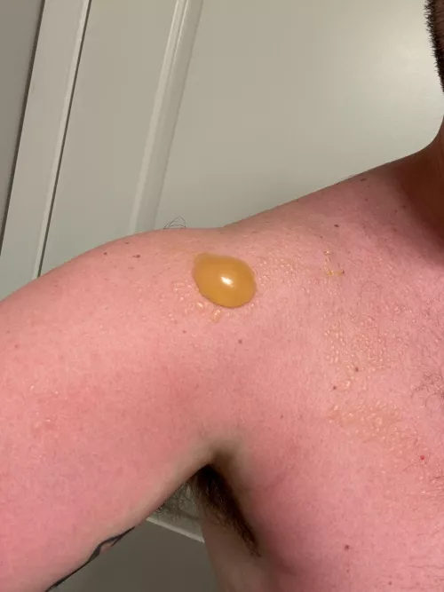 Did not reapply… sun poisoning. by Tinypotspansthings