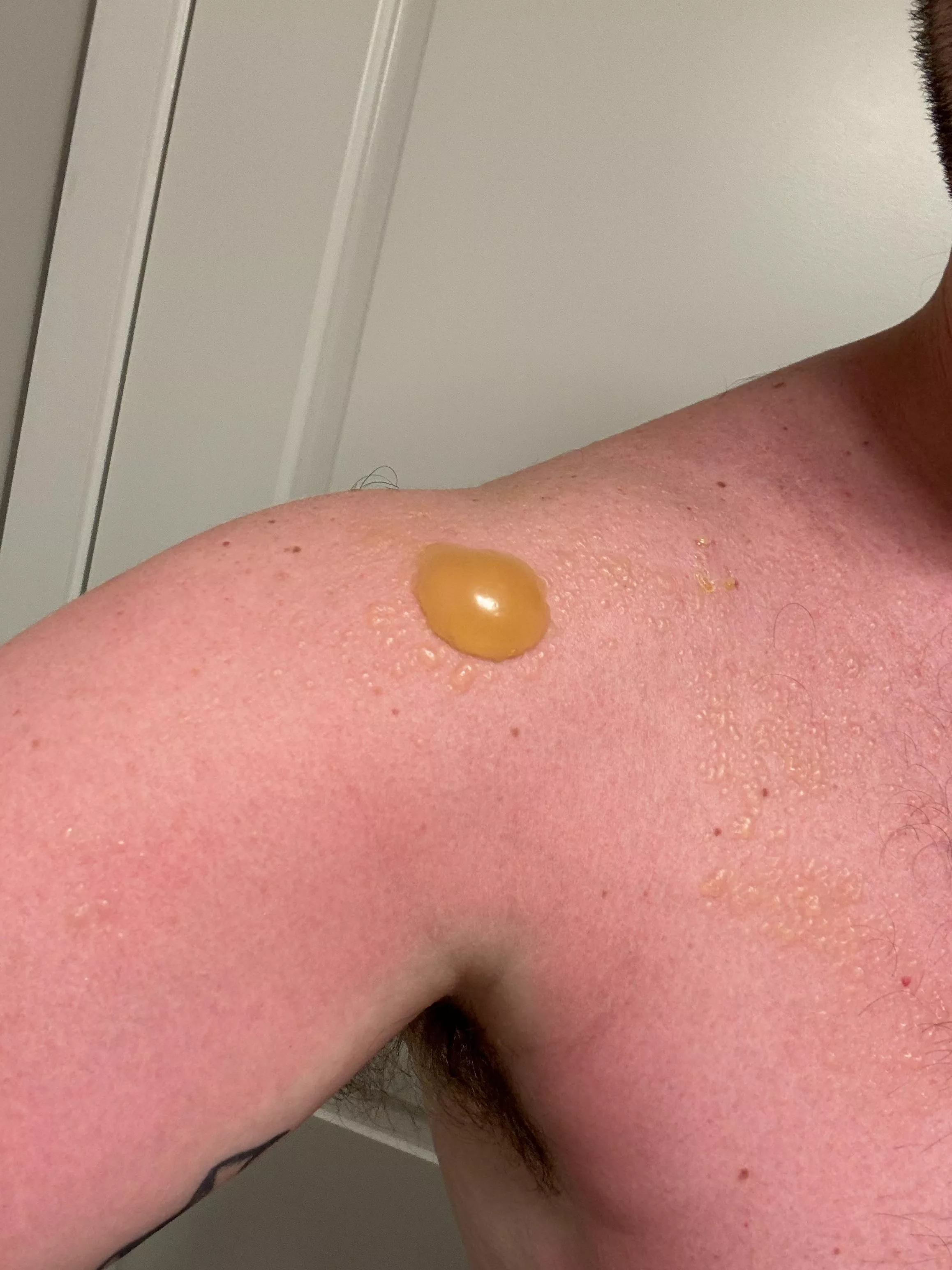 Did not reapply… sun poisoning. posted by Tinypotspansthings