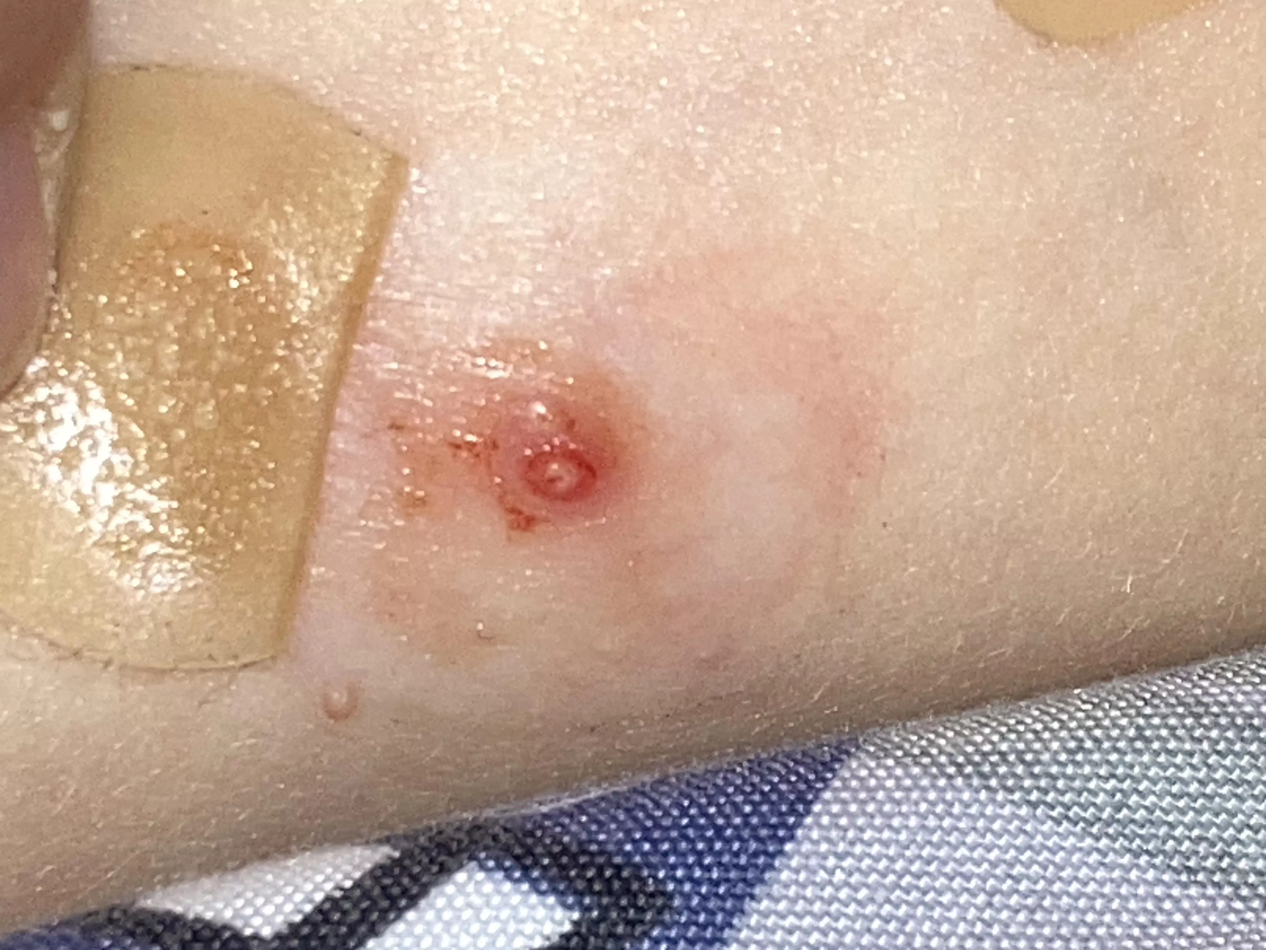 Forbidden Molluscum Pop posted by Ok_Frosting_5911