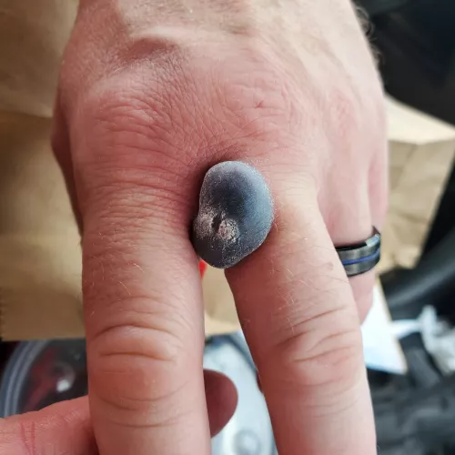 Forbidden pop - my husband got his warts froze by TepidCatastrophe