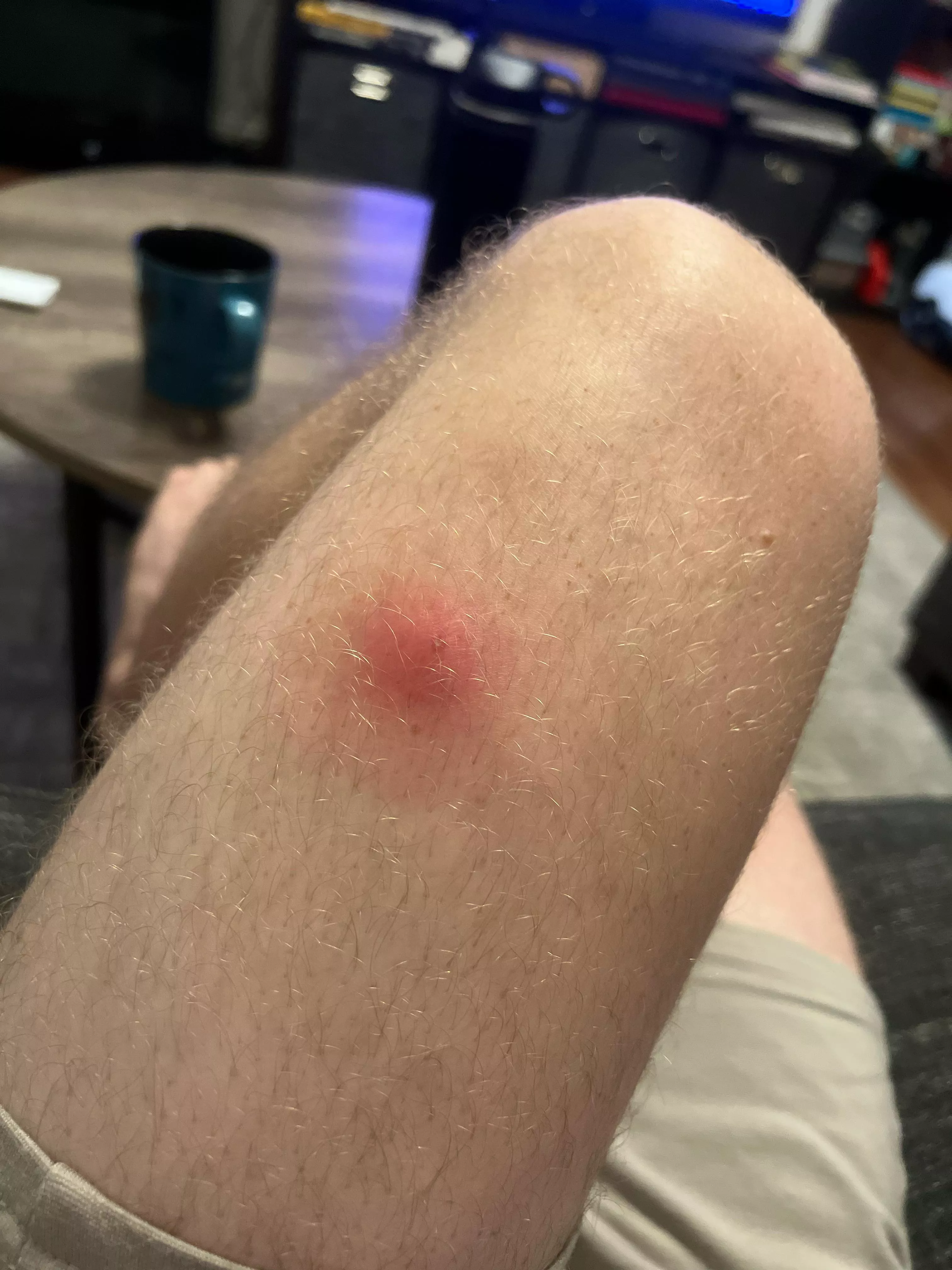 I tried popping a zit on my thigh. Inflammation ensues  posted by buns0steel