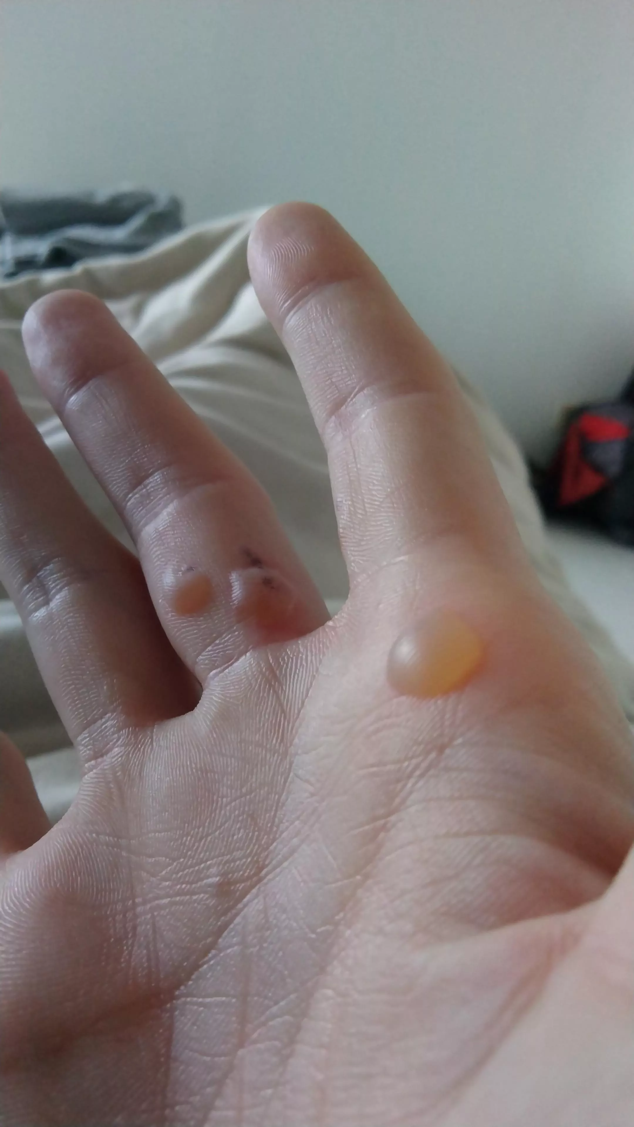 Planter wart removal w/ nitrogen pen posted by StunningUsual5580