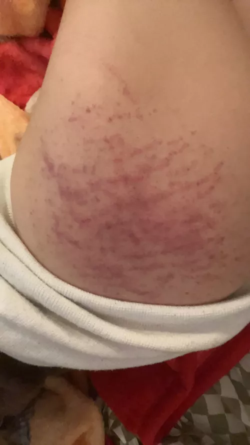 How to get rid of bruises quick by Tall_Basis3208