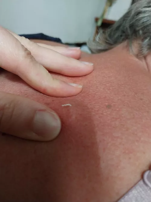 My mum had a hard bump on her back..turns out it was a blackhead/cyst  by juloath