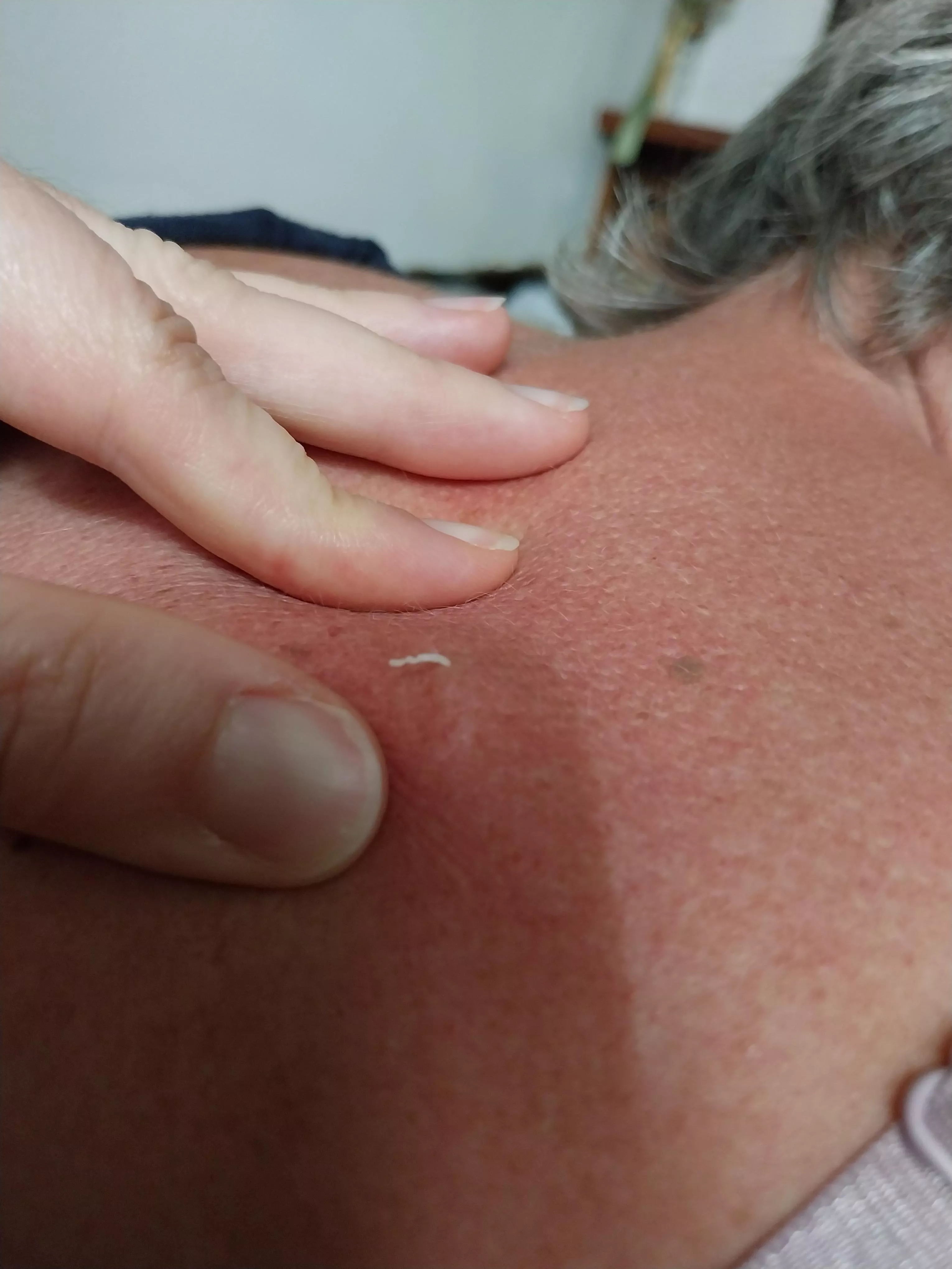 My mum had a hard bump on her back..turns out it was a blackhead/cyst  posted by juloath