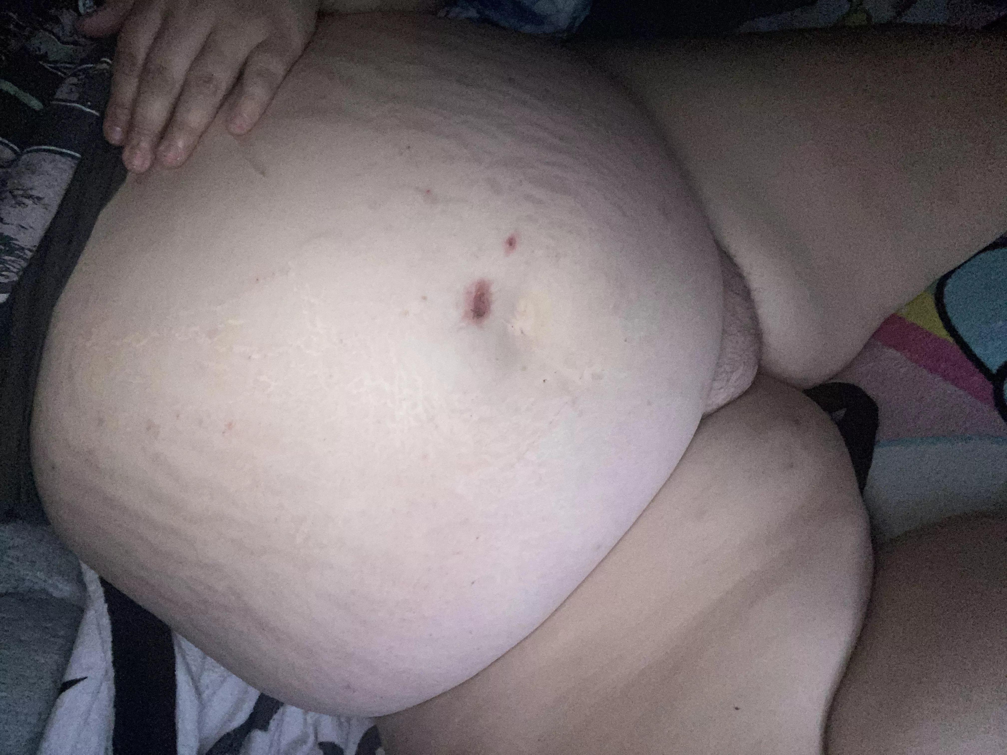 I’m so swollen  posted by xnikkixhorrorx