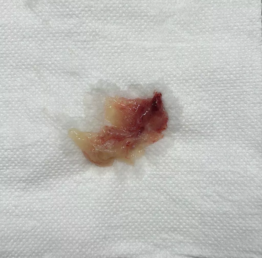 Just coughed up a storm, had this large mucus blob come out of me.  posted by MilesKilometers1