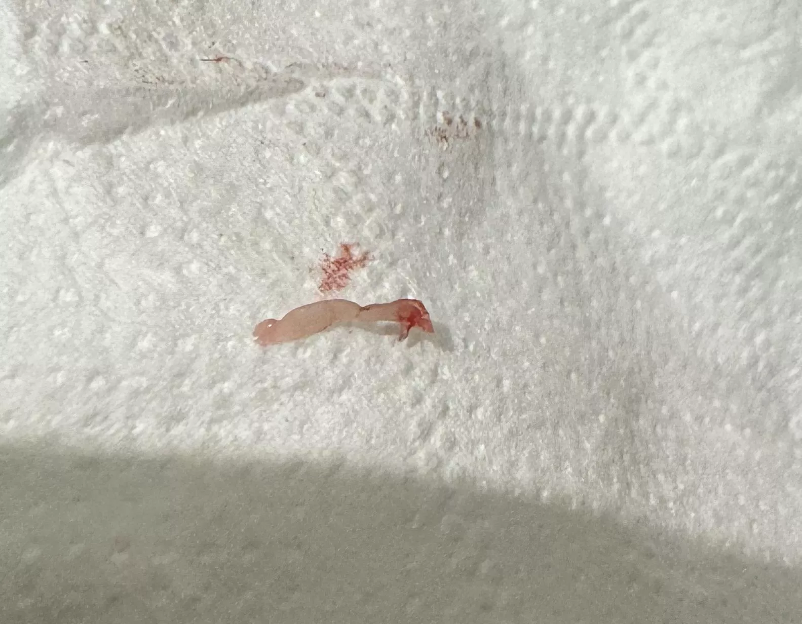 Cyst extracted thing? posted by relodebell