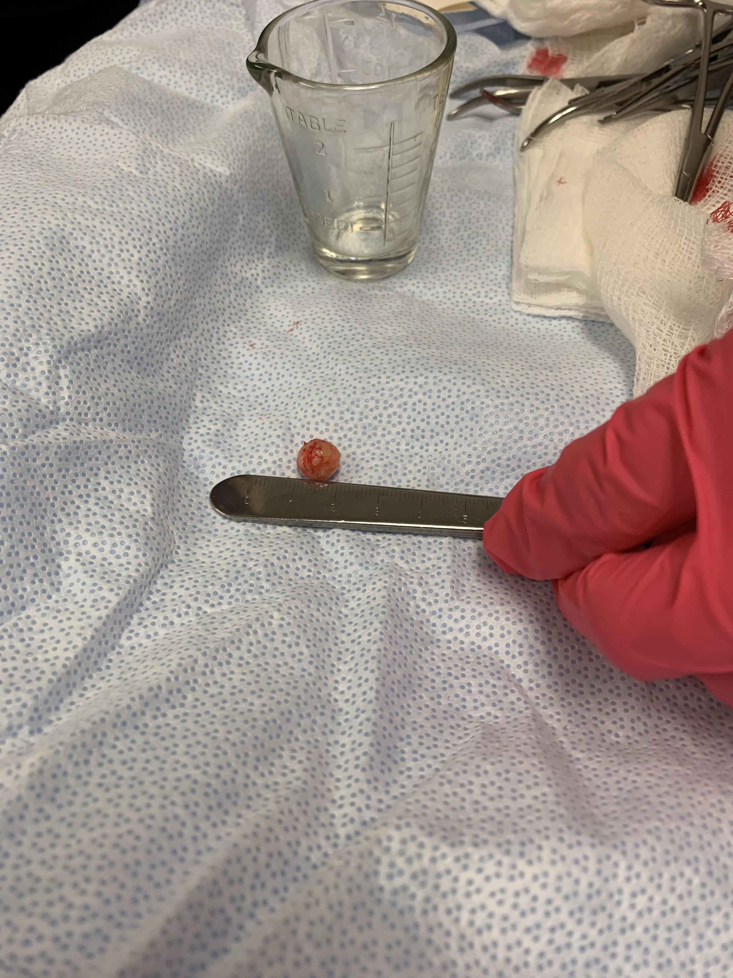 Cyst on my scalp removed! posted by OhSug