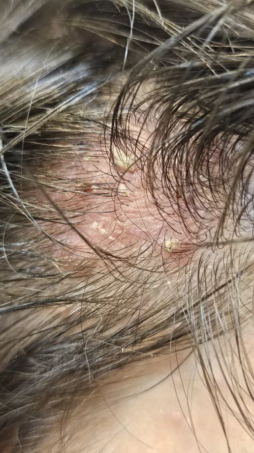 Doc says I can't pop sorry guys trust me I want to... by fiesel21