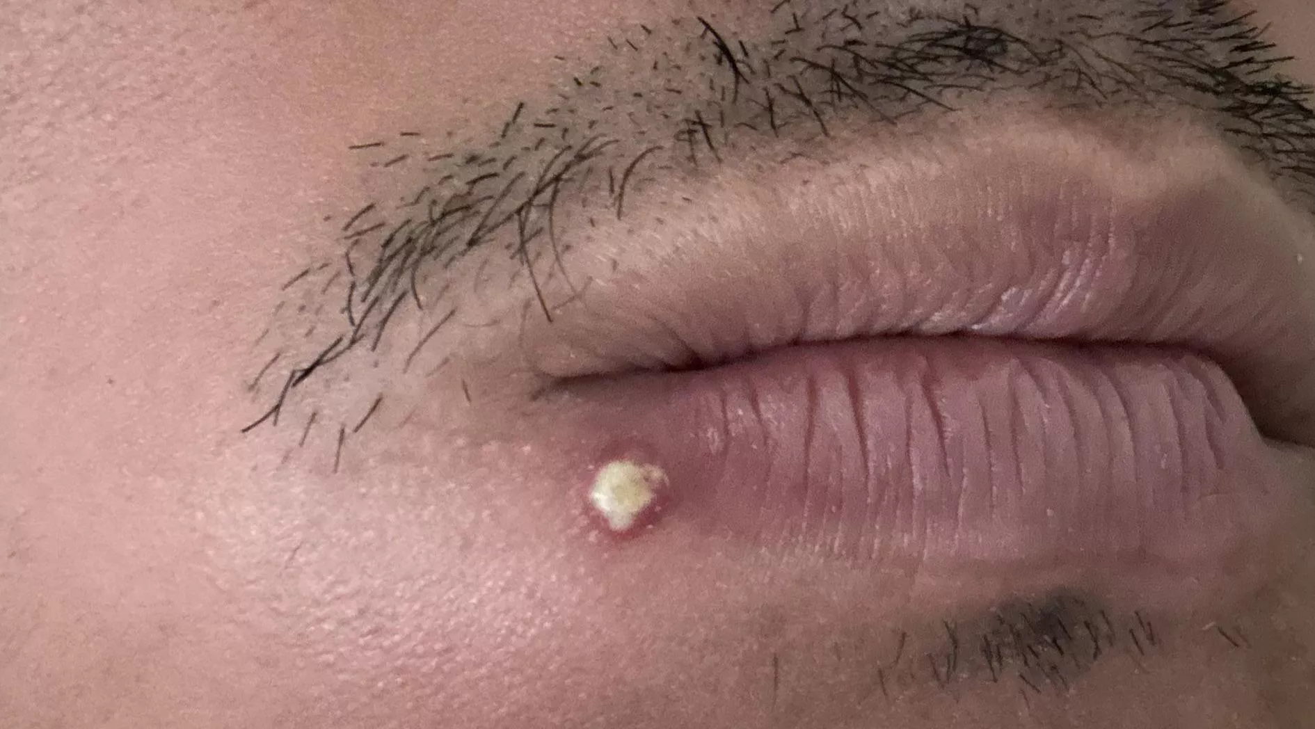 Juicy pimple!!!!!!!!!! posted by 014_Tino