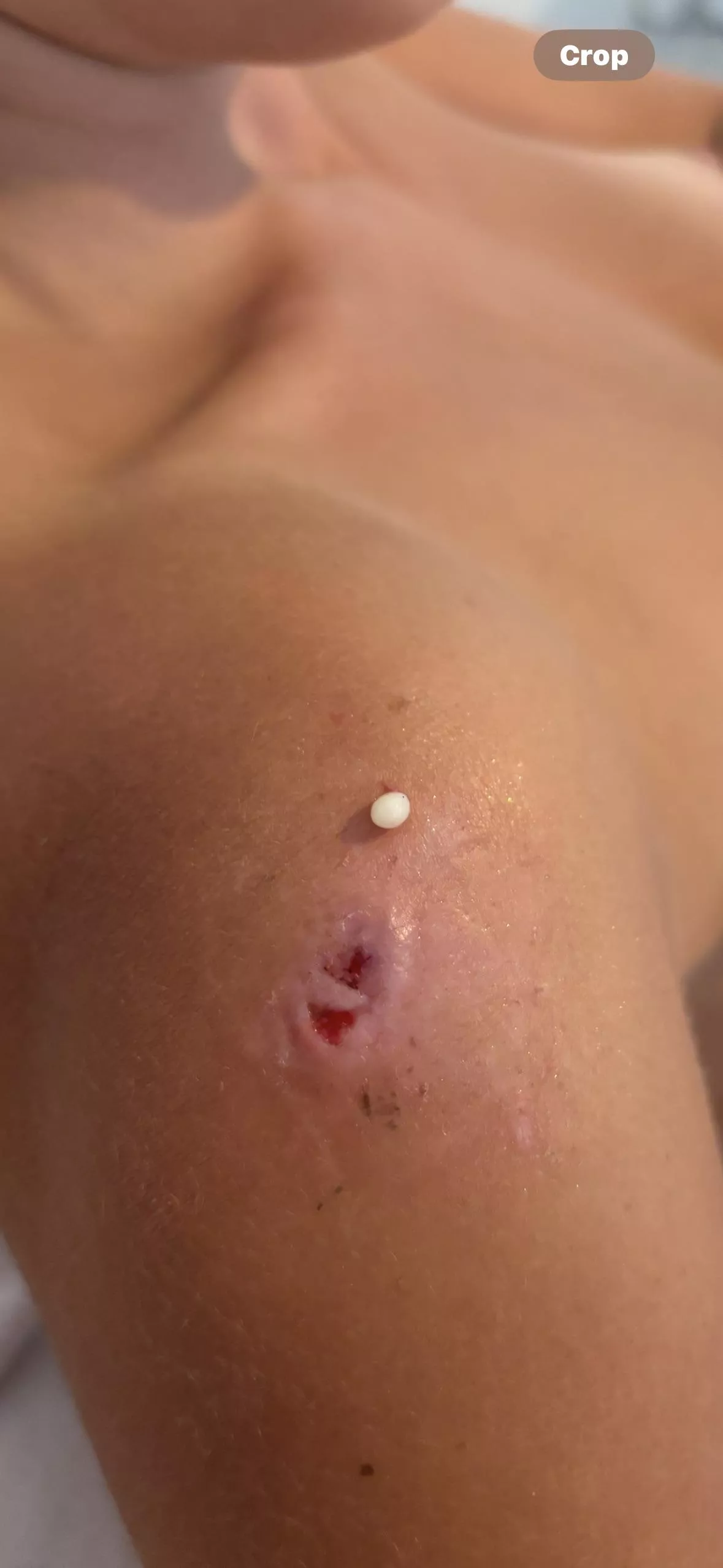 My recurring friend- tried an alternative removal process and didn't film as I didn't expect it to work! posted by Objective_Length280