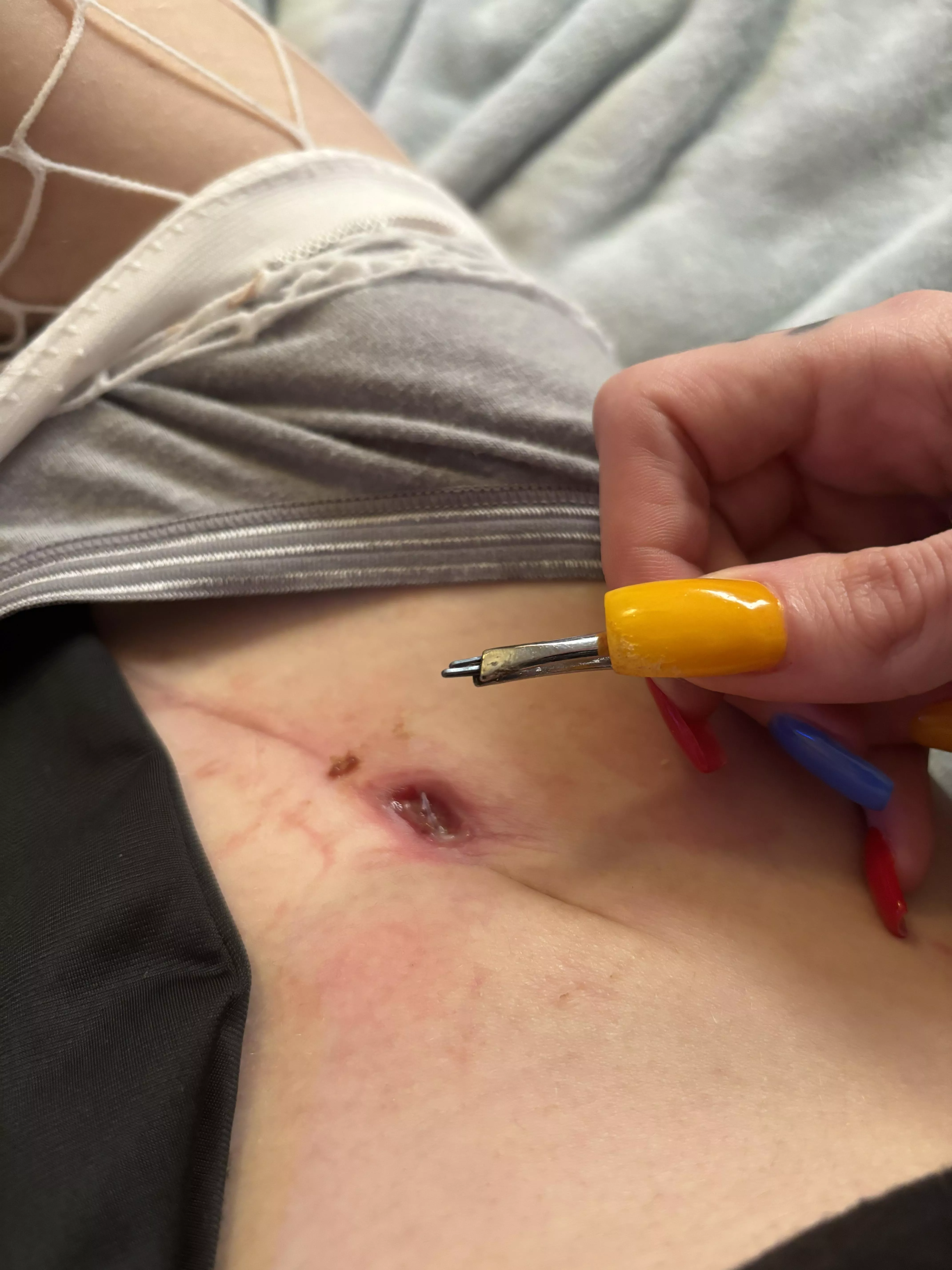 pulled out of my surgery scar posted by tiffbitts