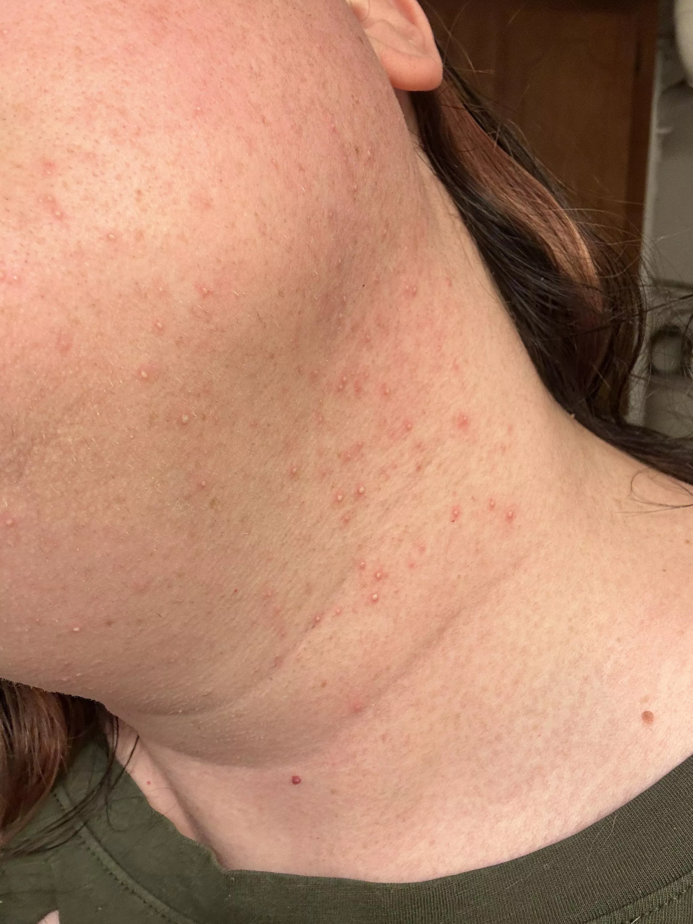 This is what my neck looks likes for a few days after doing laser hair removal.  posted by Glory32Sailor