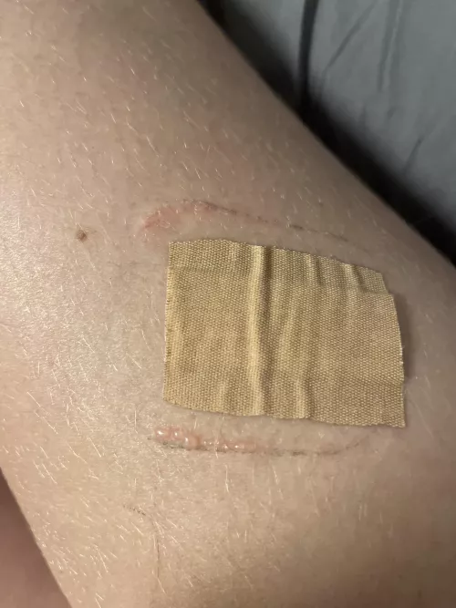 I had an reaction to wound dressing  by Deathoria