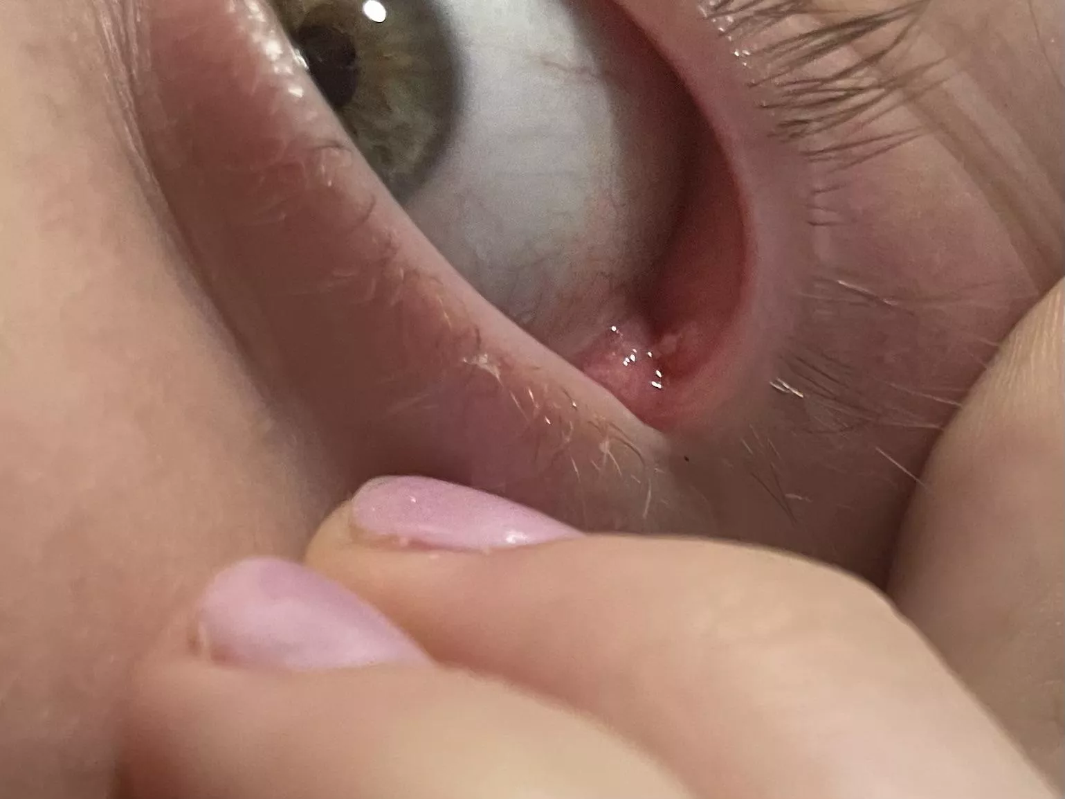 Accidentally popped stye on inner eyelid!  posted by bigstink3r