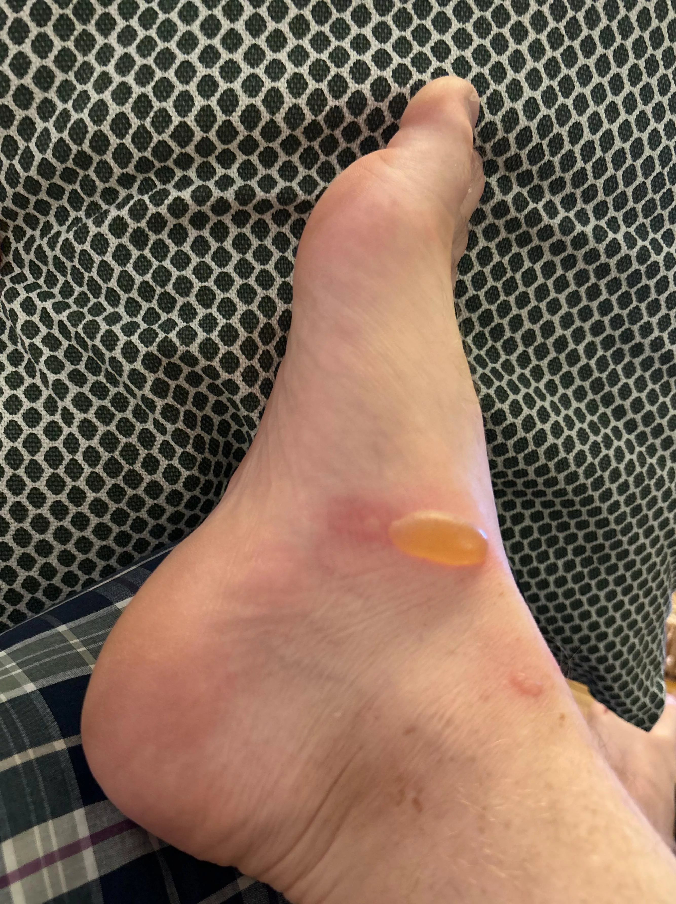 I got sap from a fig tree on my foot posted by Beached_is