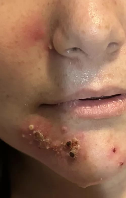 Caught a staph infection somehow. Ignore the sweat I was in the hospital for a Crohn's disease flare up  by overactivemango