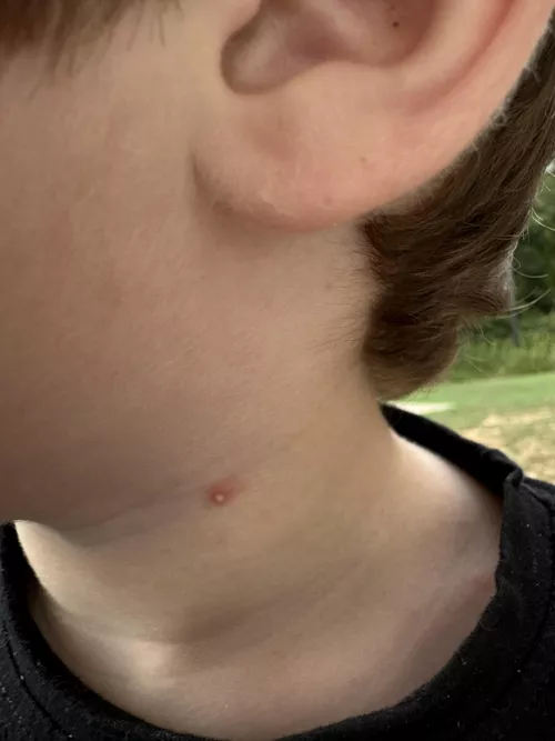 Forbidden pop, this popped up on my 2 year olds neck.  by Cjd2x