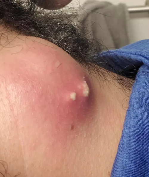 It's getting angry! big boy cyst ready to blow by leof135