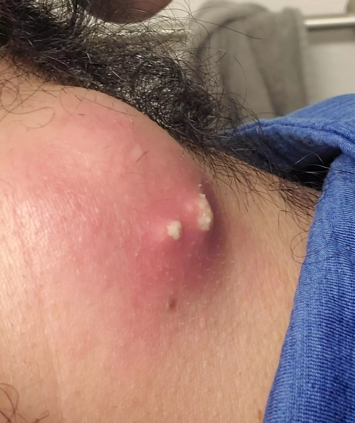 It's getting angry! big boy cyst ready to blow posted by leof135