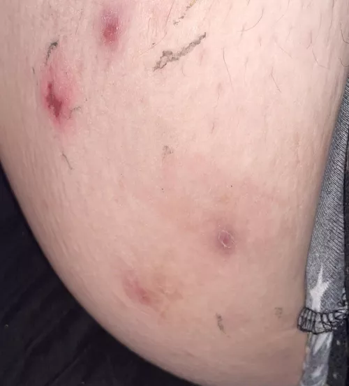 2 healing cysts and bandaid reactions. Ouchie. 🥲 by bigtittymothgf96