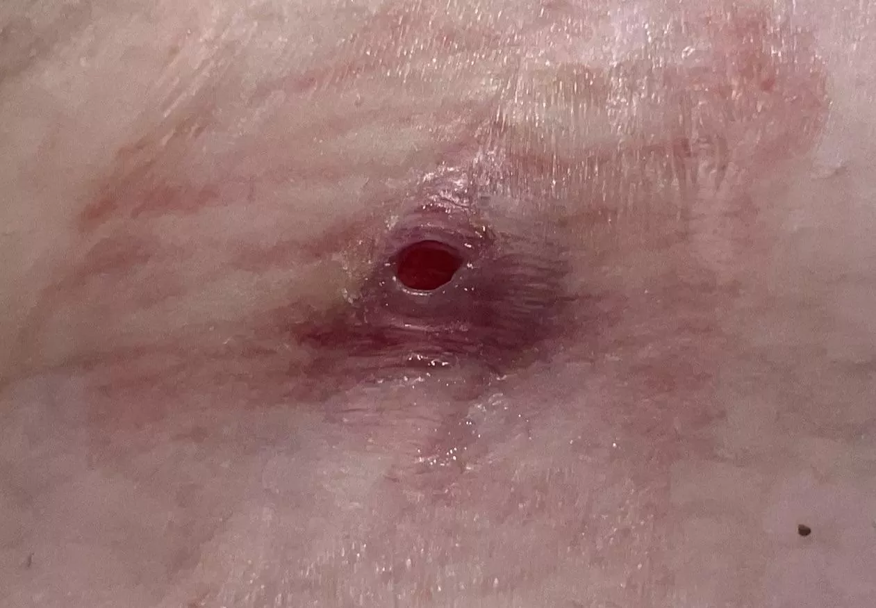 Check out my first ever boil CRATER posted by raw100513