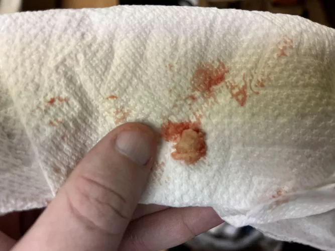 Cyst I just birthed out of my shoulder by IAN42o