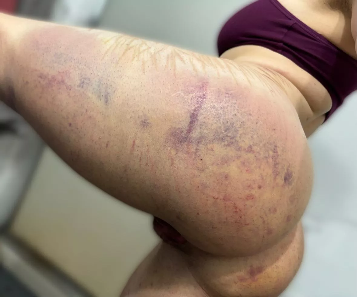 aftermath from a beating posted by eyelinertattoo