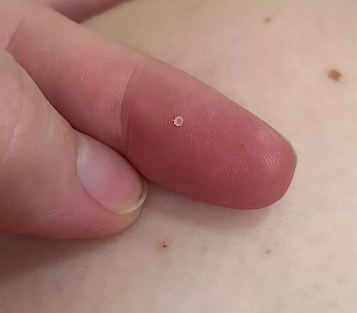 The tiniest, most perfect cyst sac 😂 posted by tallglassofanxiety