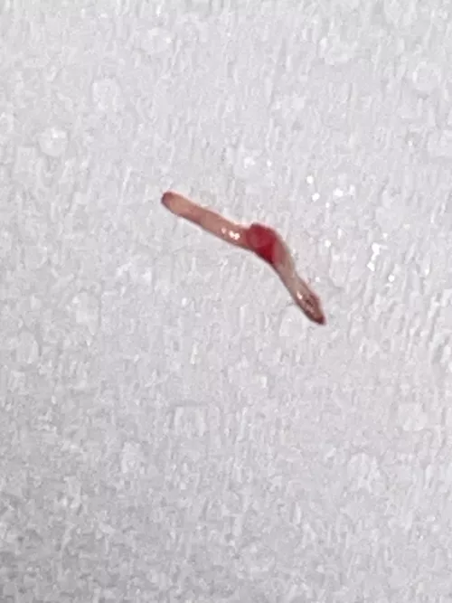 In-grown hair SAC!! Amazing and no more pain  by Transition_Humble