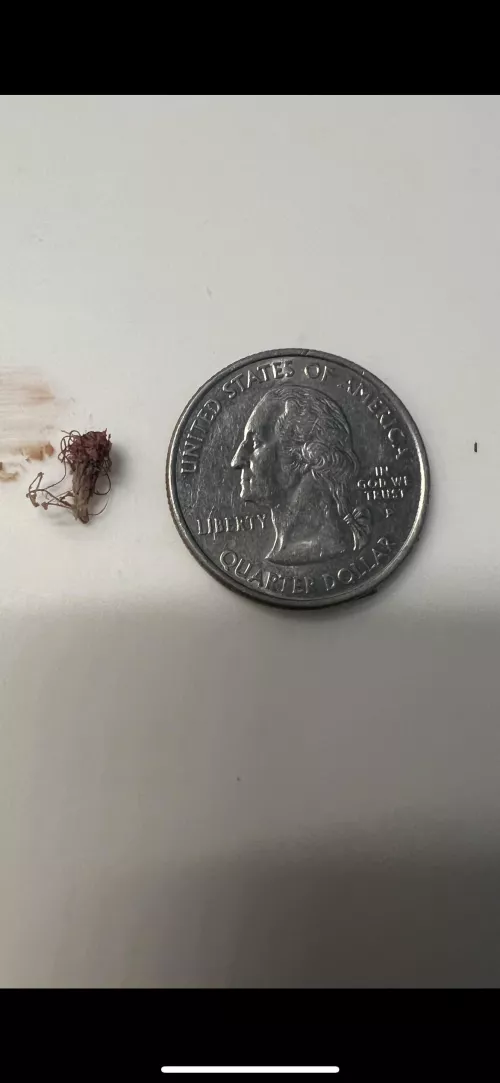 Ingrown hair of 6-7 years, pubic area.  by ThatZX6RDude