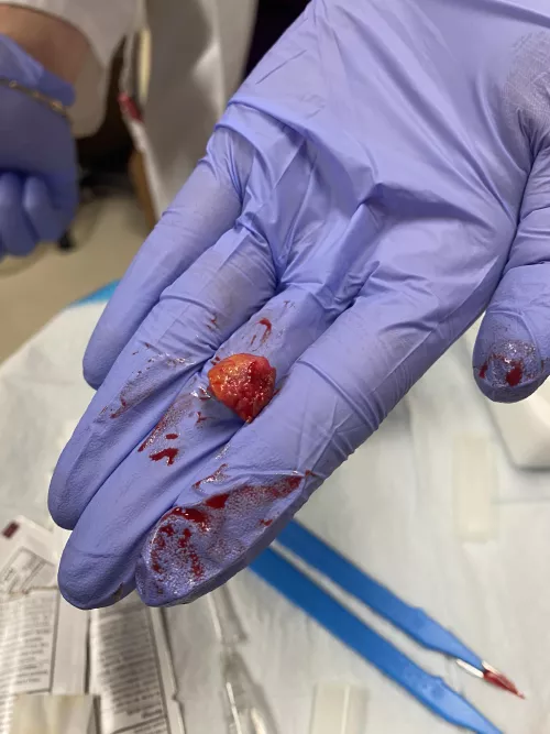 Had this little jewel removed today  by redmini-s