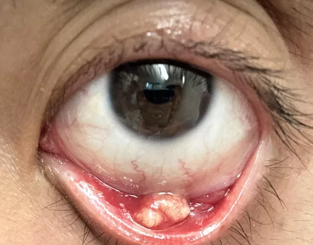 Biggest stye I’ve ever had by mattbdo5