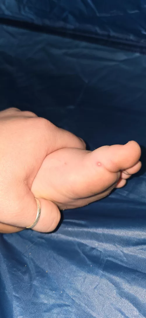 Forbidden pop on toddler's foot. Fire ant bite 😫 by penelopewonton