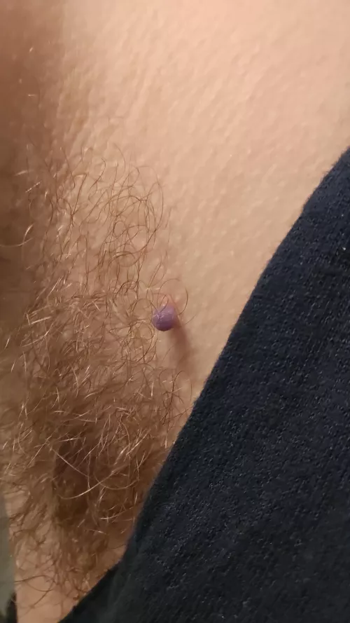 My skin tag about 22 hours after freezing  by sweetwoftedmust