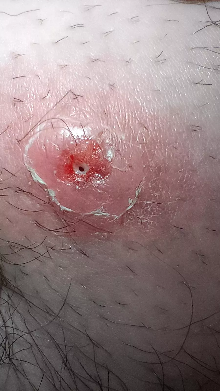 Update from thigh pop  posted by Johnny3pony