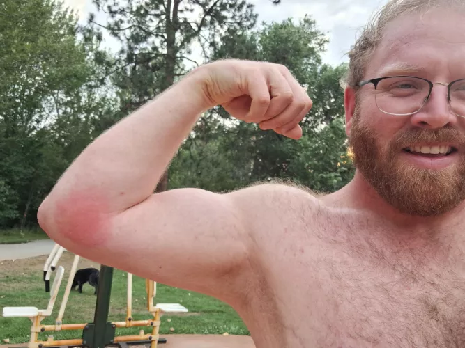 Hi from Boise, Idaho! Here you can see I got a wasp sting on my arm. Abundant wildlife, just one of the reasons to come visit Idaho 🥔 by PlantsandGuys