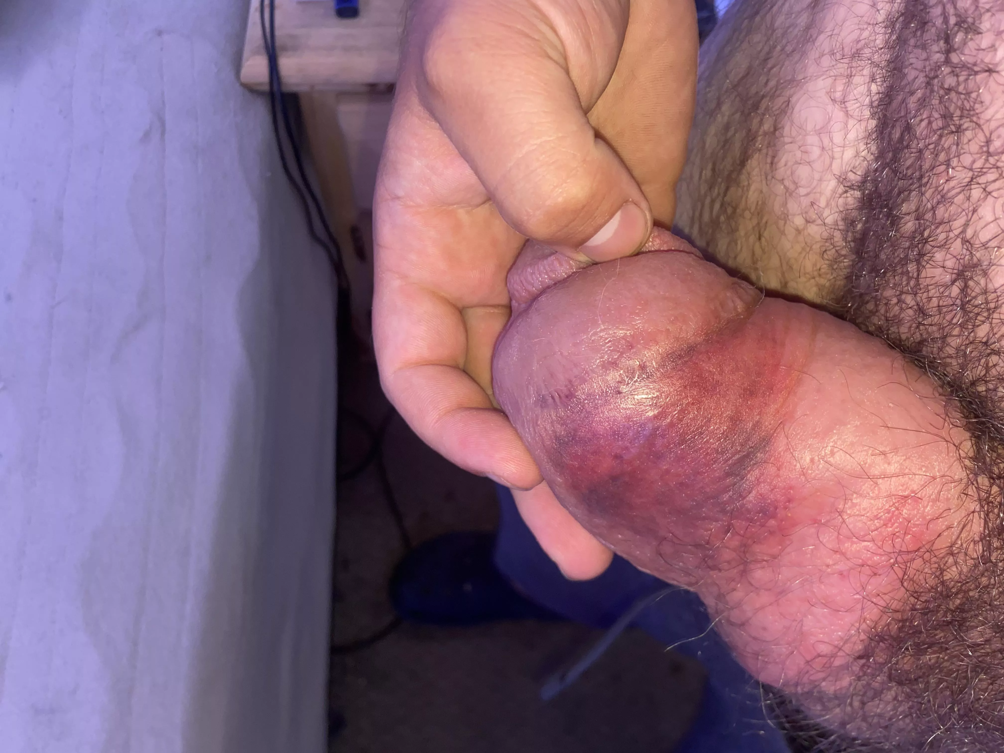 Is this bruising something to be concerned about? posted by boosted__24