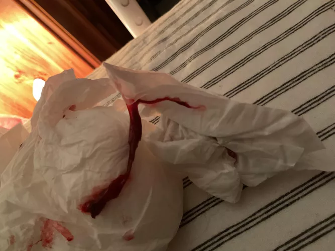 Just pulled this out of my nose by Spfromau