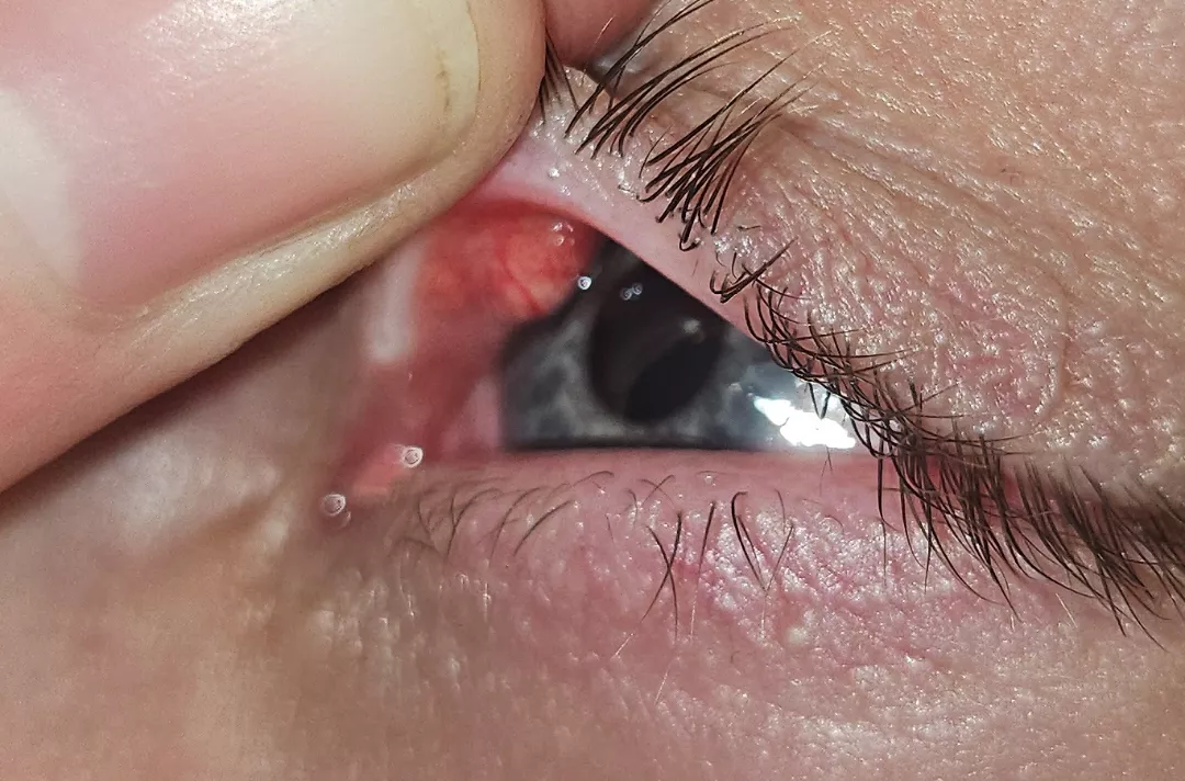 Found this possible stye in my friends upper eyelid  posted by TinyBigTiddyGothGF