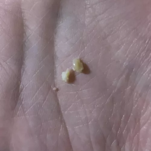 Just got this unexpectedly massive blackhead thing out of my side, sadly didn't get it on video :( by R3DR0PE
