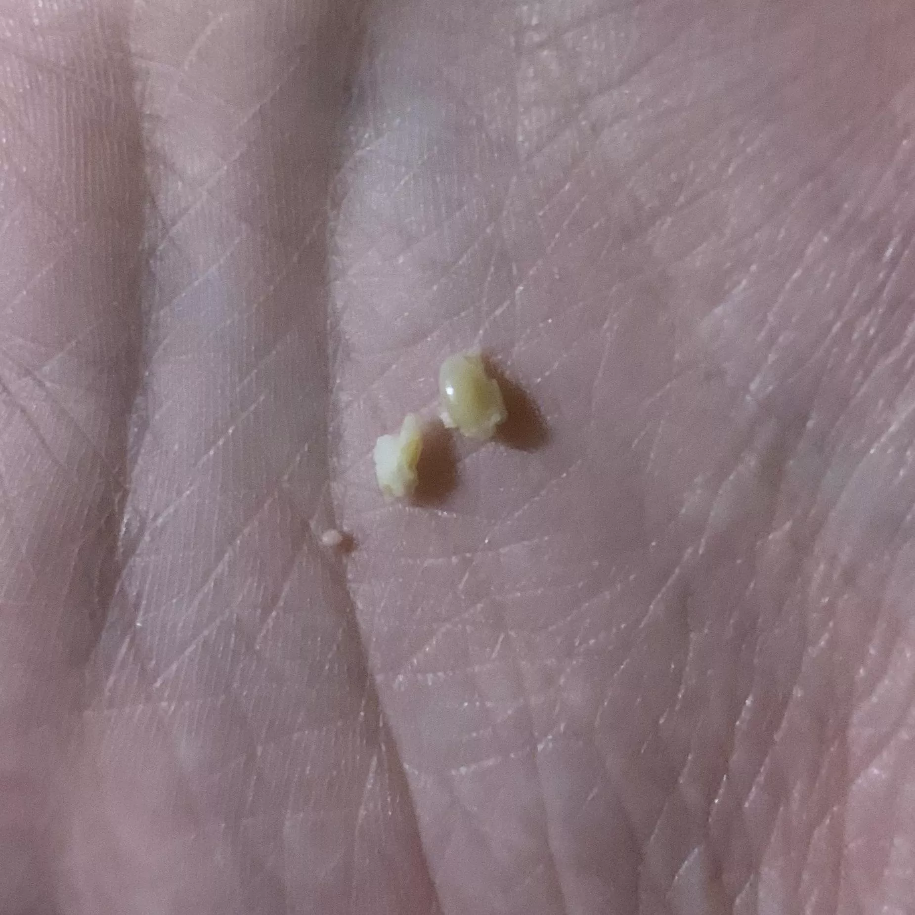 Just got this unexpectedly massive blackhead thing out of my side, sadly didn't get it on video :( posted by R3DR0PE