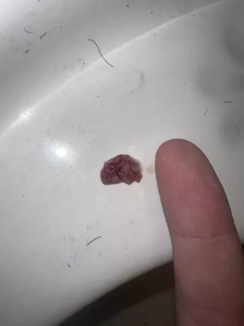 Heres a terrible tonsil stone that formed while I had tonsillitis the past week and a half. (Finger for scale) by Stunning-Willow-7204