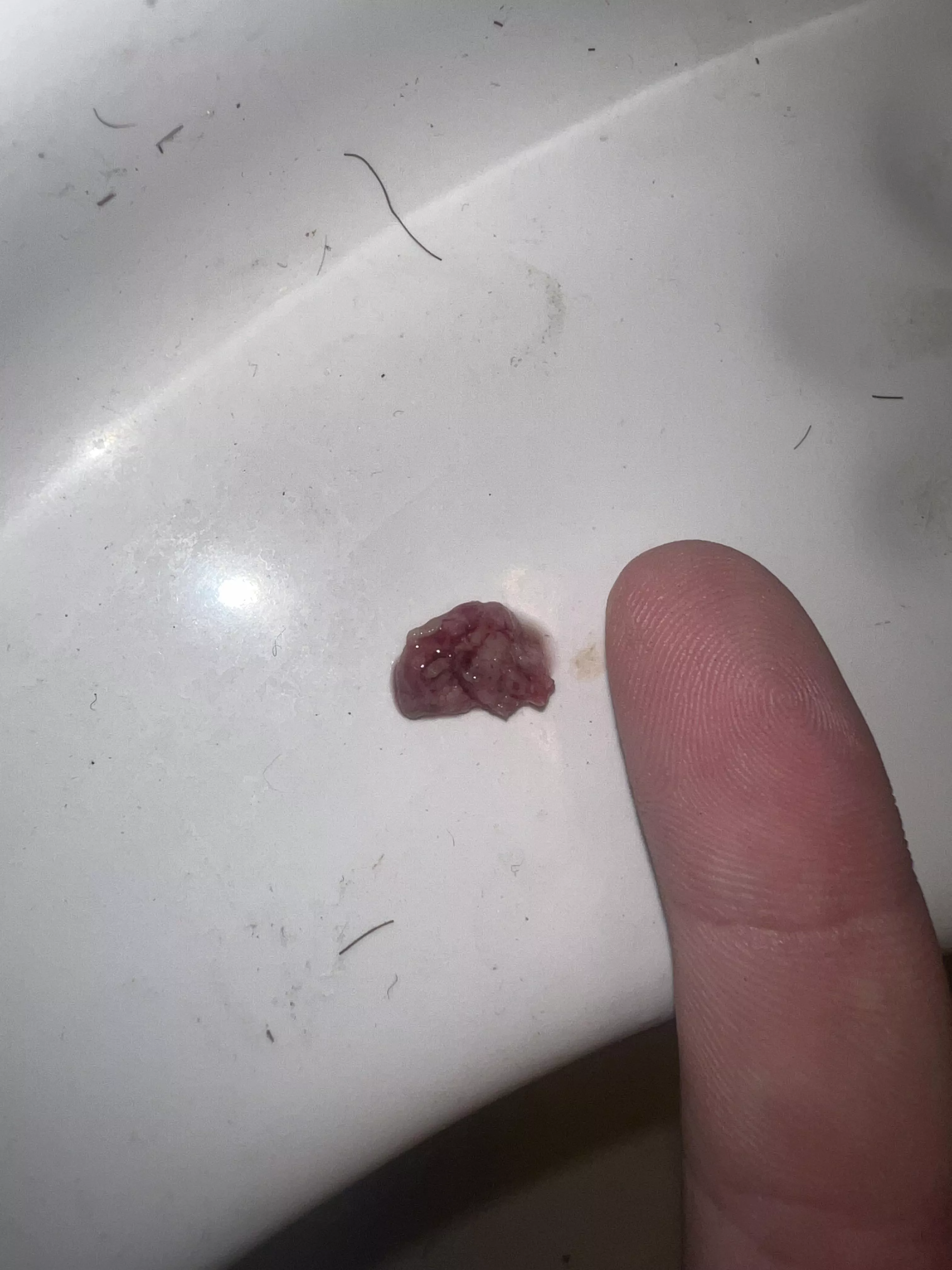 Heres a terrible tonsil stone that formed while I had tonsillitis the past week and a half. (Finger for scale) posted by Stunning-Willow-7204