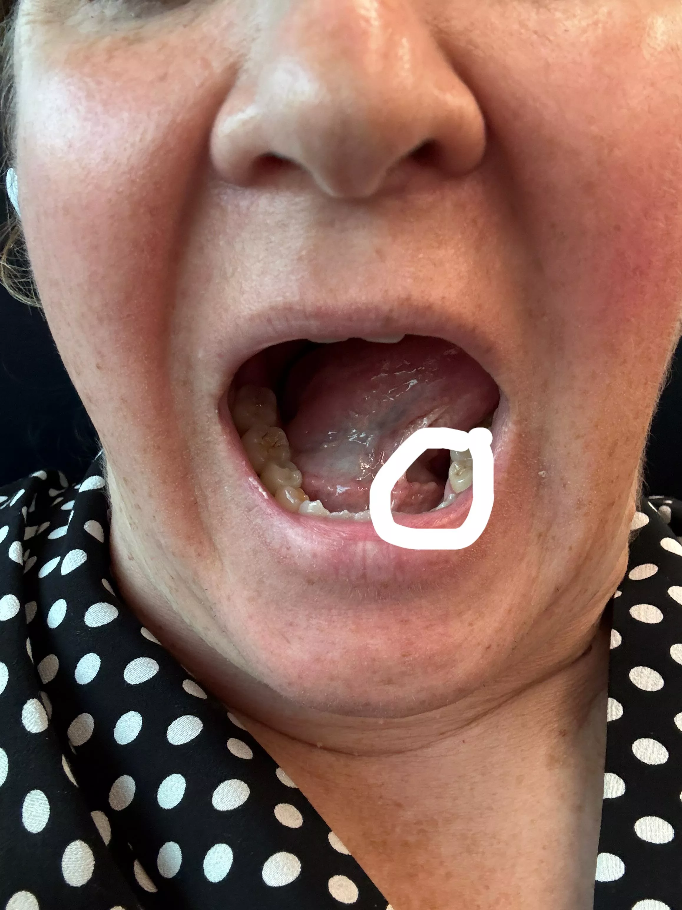 Salivary stones in submandibulsr gland  posted by sachgra