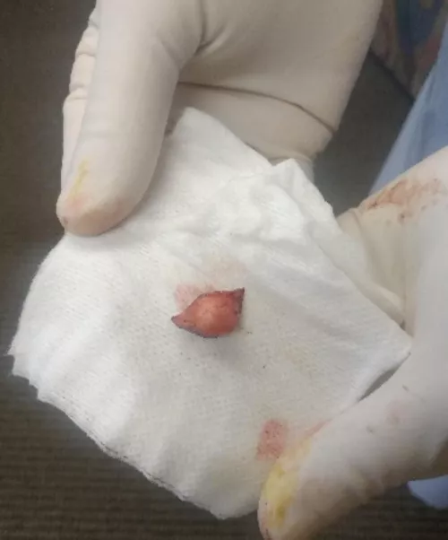 Cyst removed from temple  by CreepyConsequence_