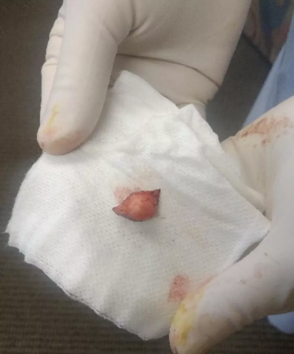 Cyst removed from temple  posted by CreepyConsequence_
